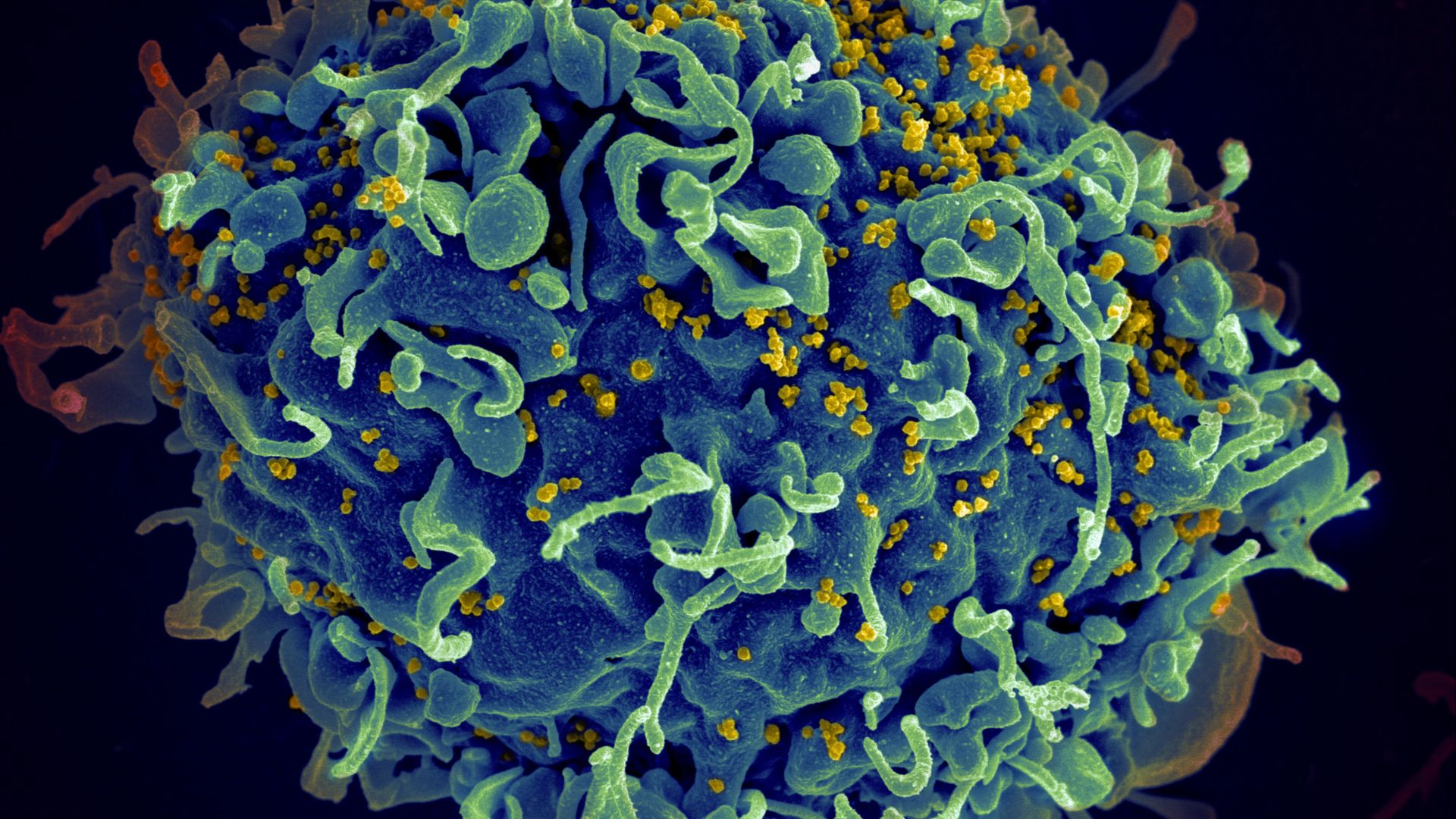 File:Scanning electron micrograph of a human H9 T cell infected with HIV virus particles.jpg