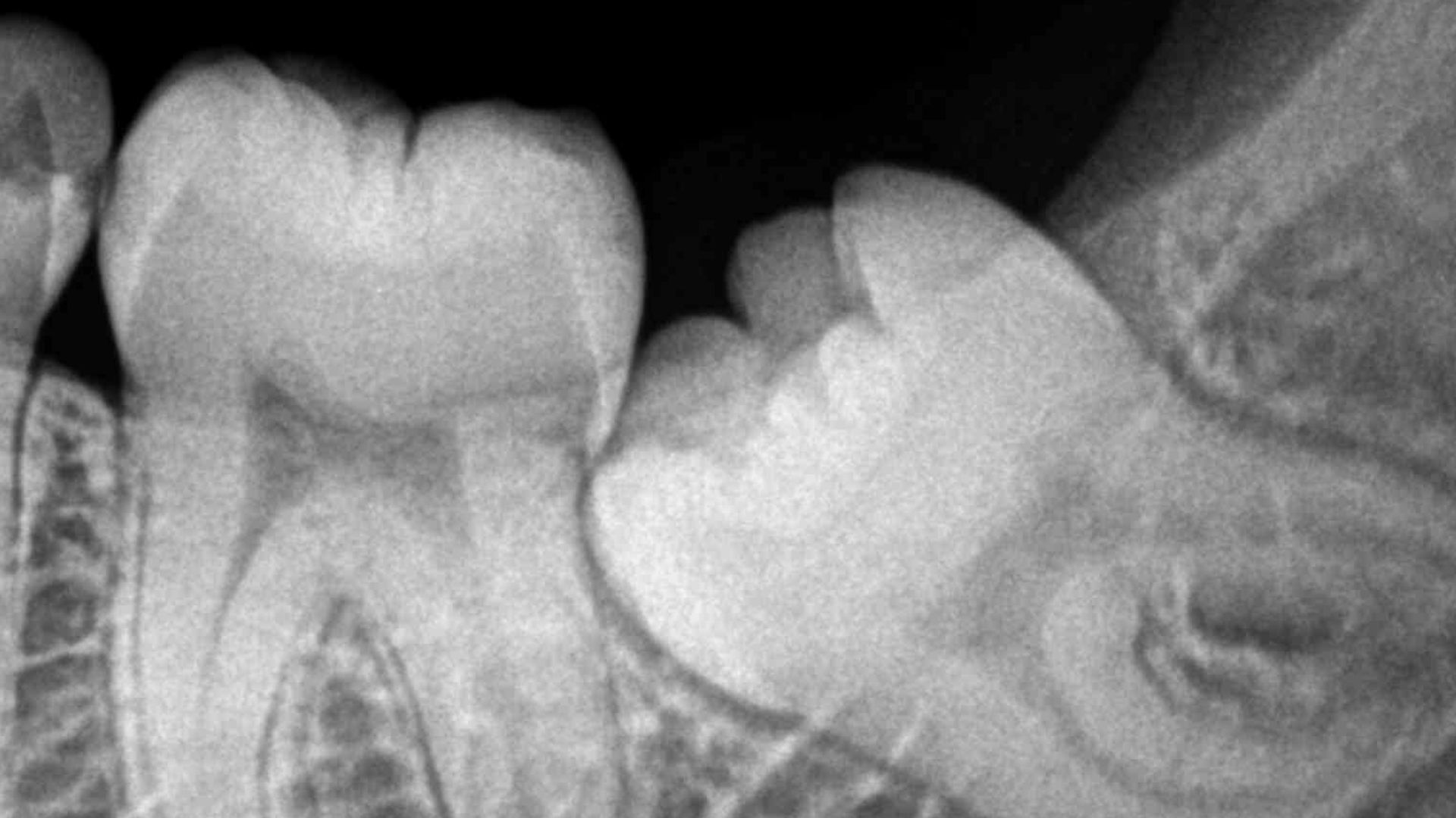 File:Impacted Wisdom Tooth aka Lower Left Third Molar 38 RVG IOPA Xray.jpg
