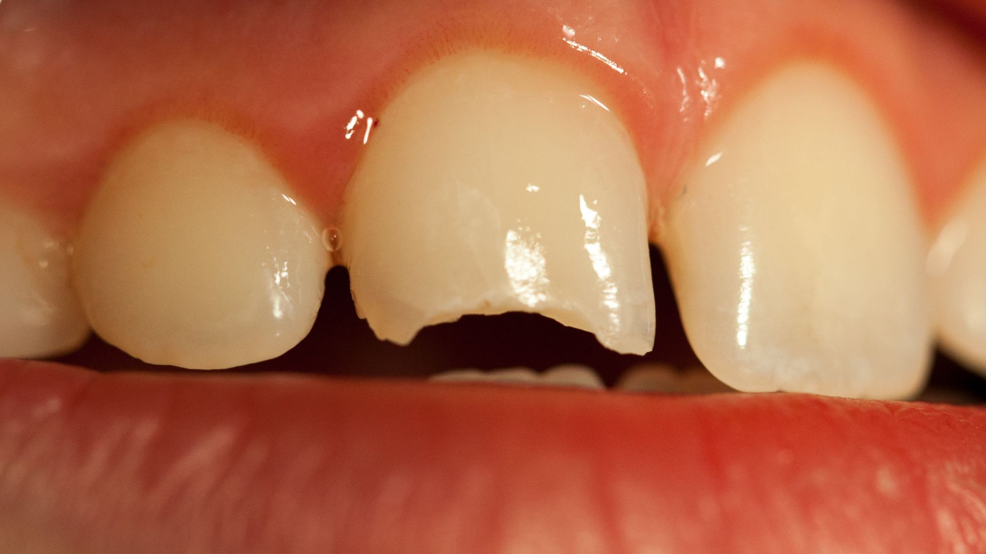 File:Frontzahn, Schneidekante abgebrochen, PD 2020-2.jpg