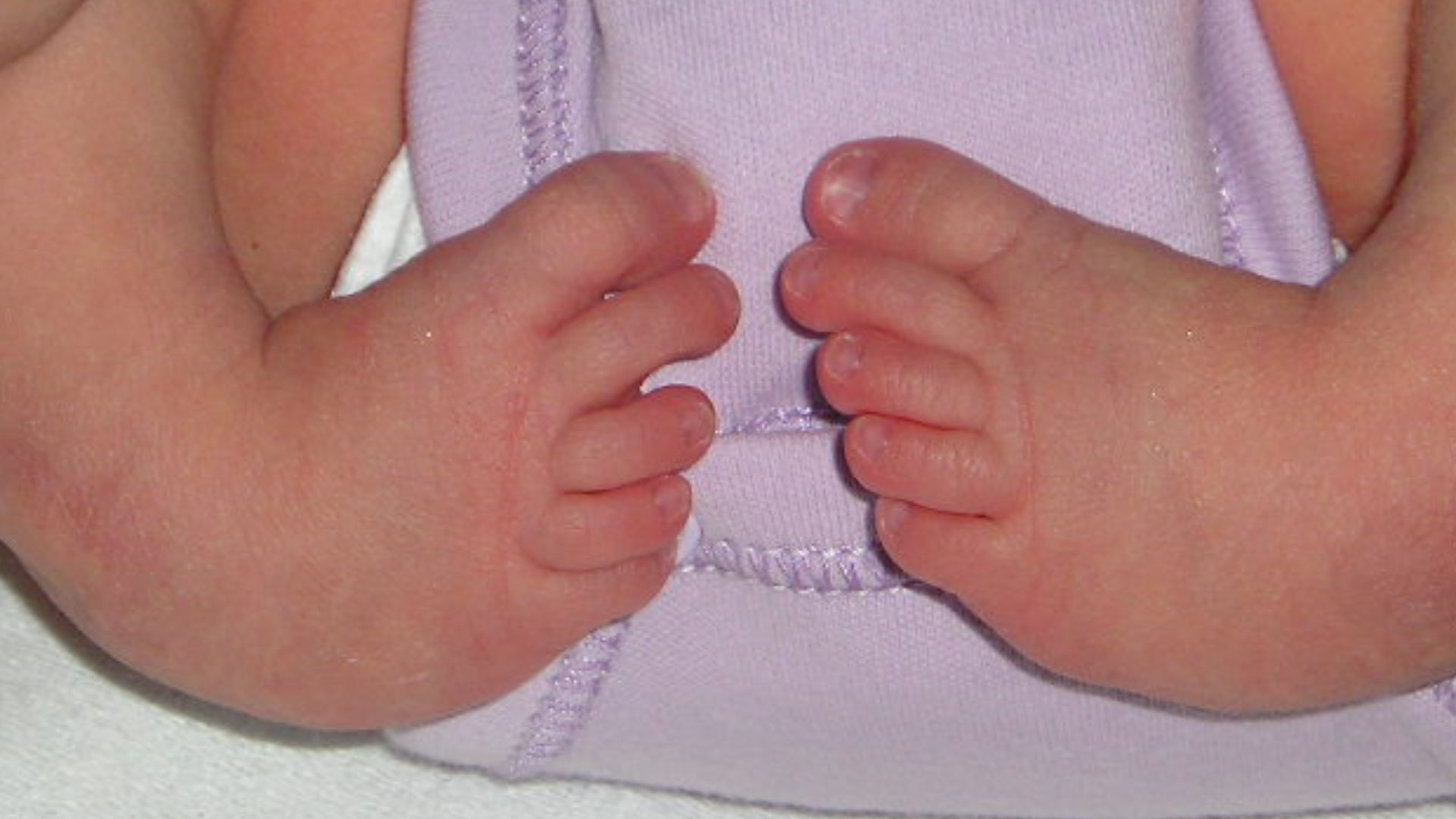 File:Pied bot, varus équin (bilateral).jpg