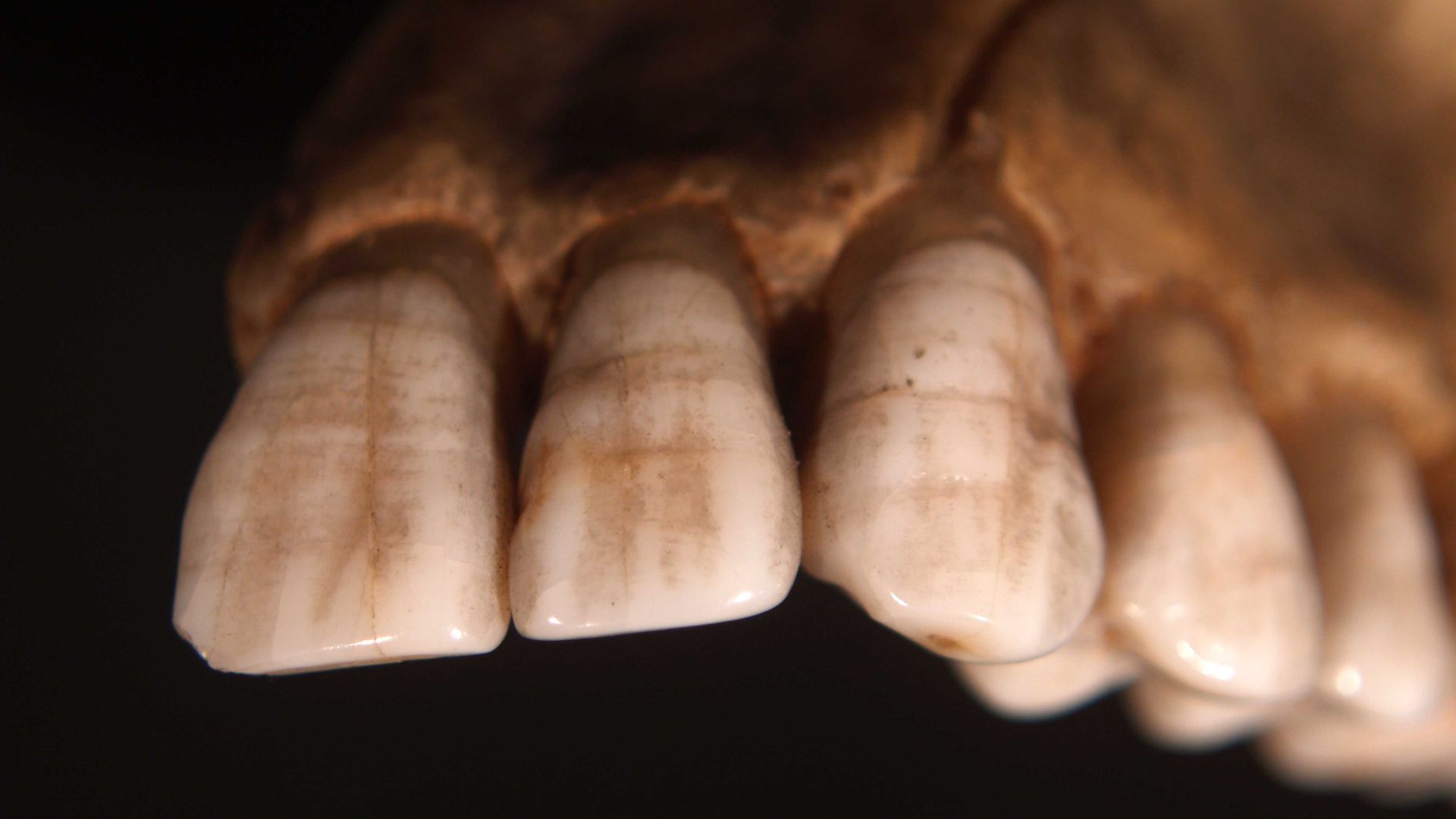 File:Teeth displaying Enamel hypoplasia lines.jpg