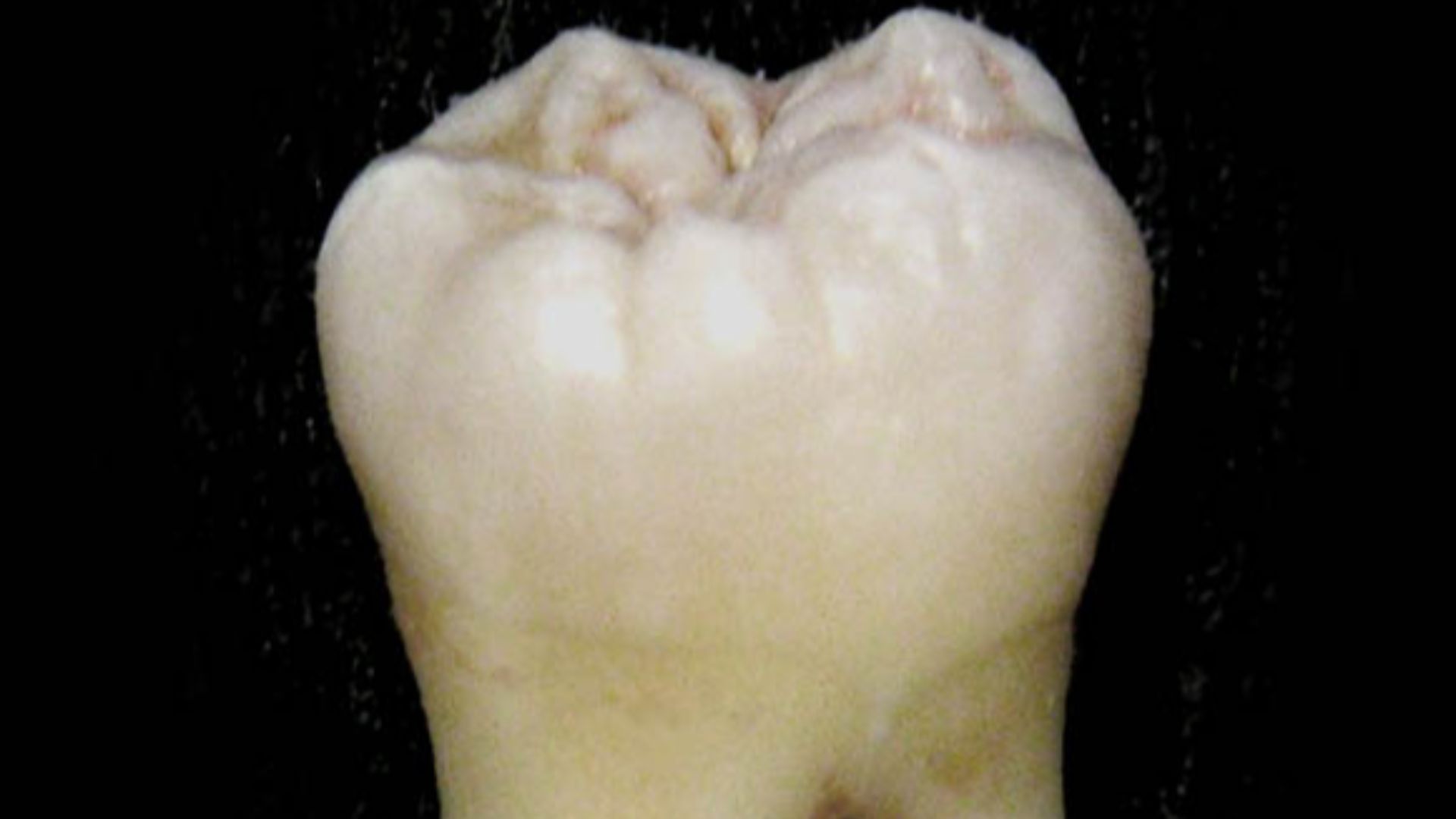 File:Lower wisdom tooth.jpg