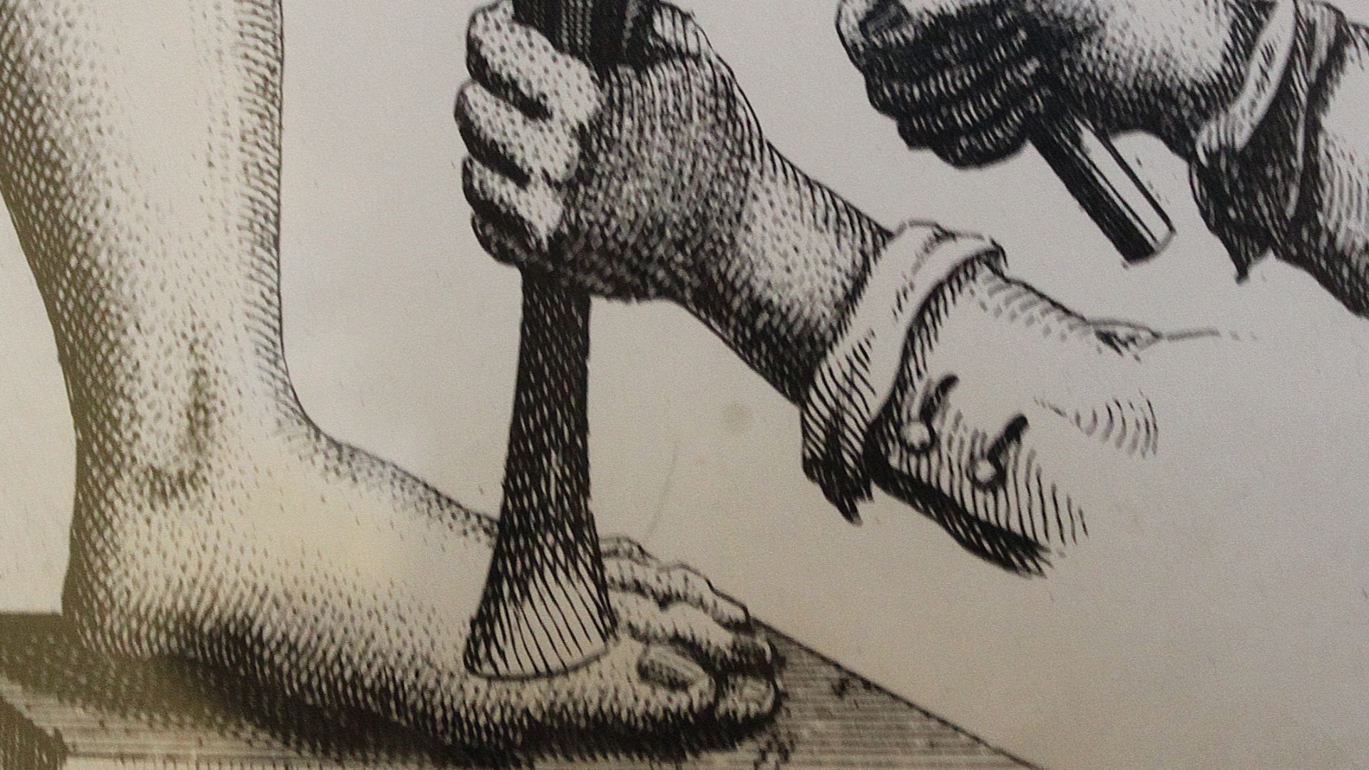 File:BLW Anatomical Print - amputation.jpg