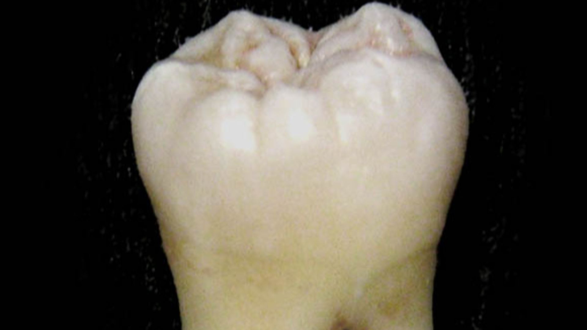 File:Lower wisdom tooth.jpg