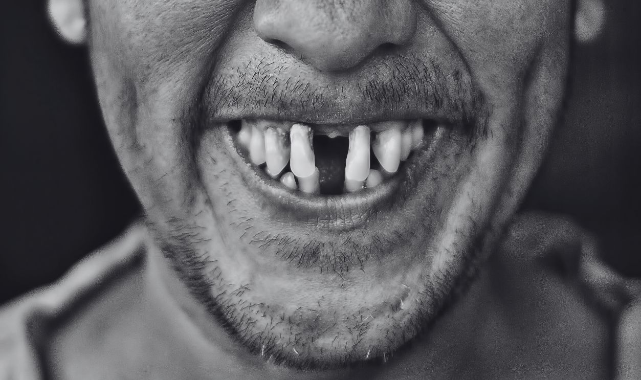 A joyful man showing a wide smile with missing teeth, expressing humor and happiness