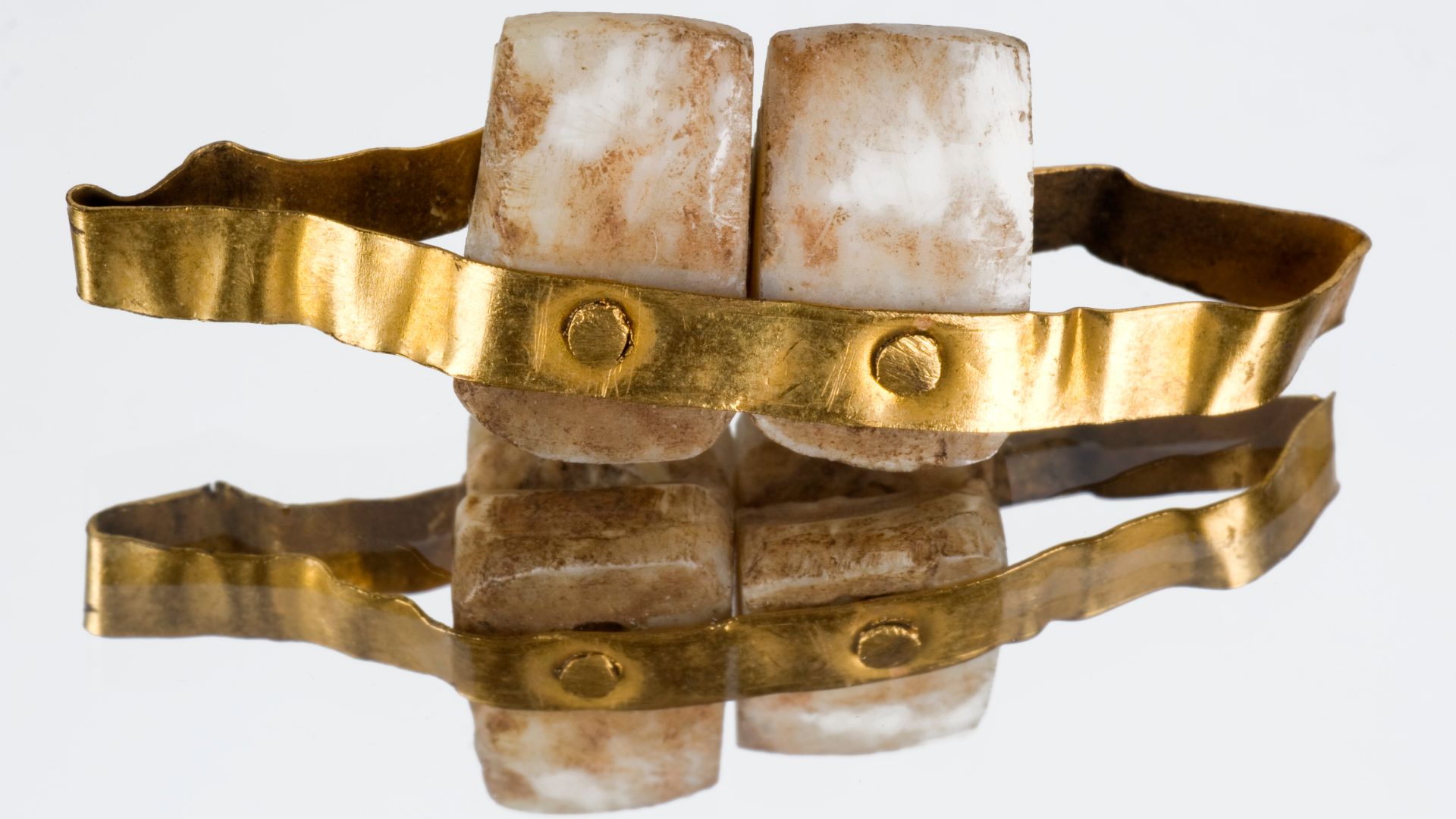 Etruscans, people living in Etruria (Umbria and Tuscany, Italy), were the first to make dentures and false teeth, from 700 BCE onwards. Teeth from another person or an animal, such as an ox, were inserted into a band of gold with a metal pin and fitted on