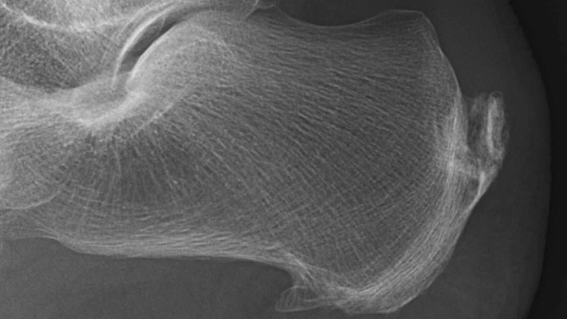 File:Achilles insertional calcific tendinosis.jpg