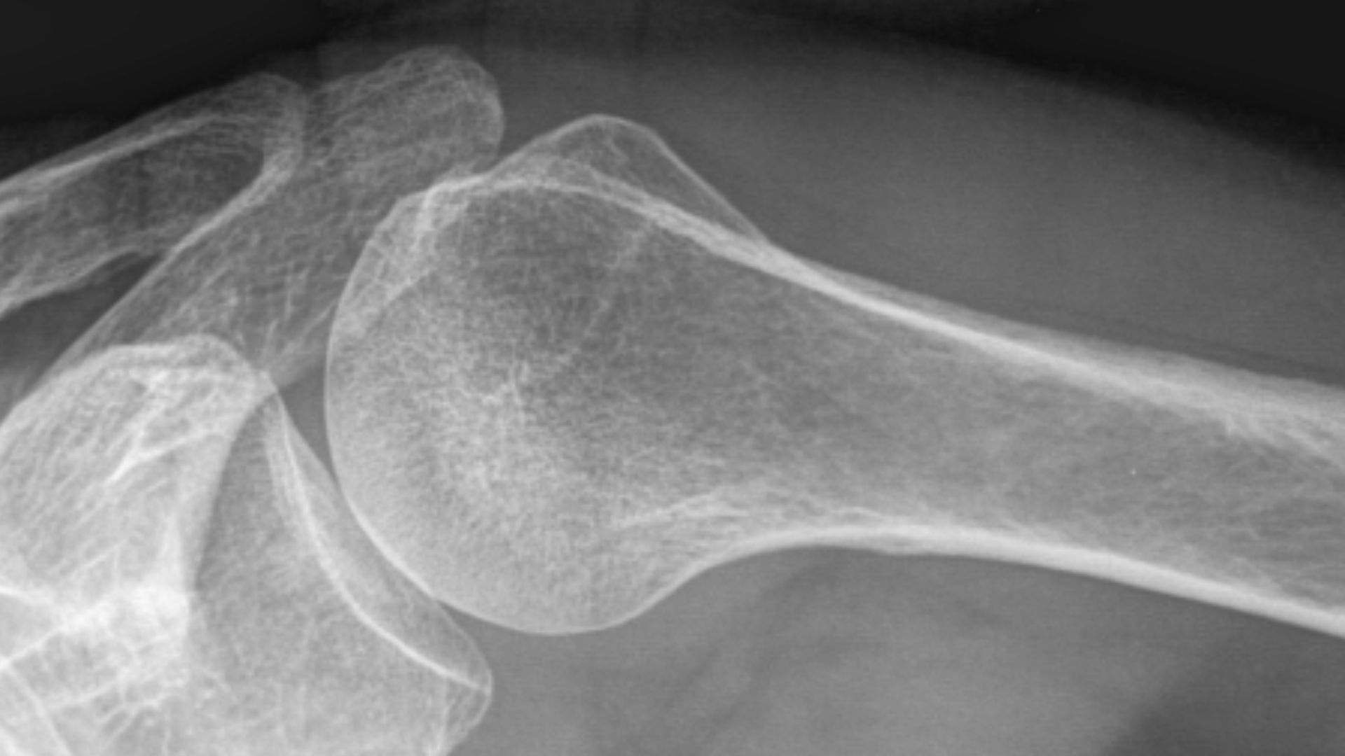 File:Transaxillary CR shoulder.jpg