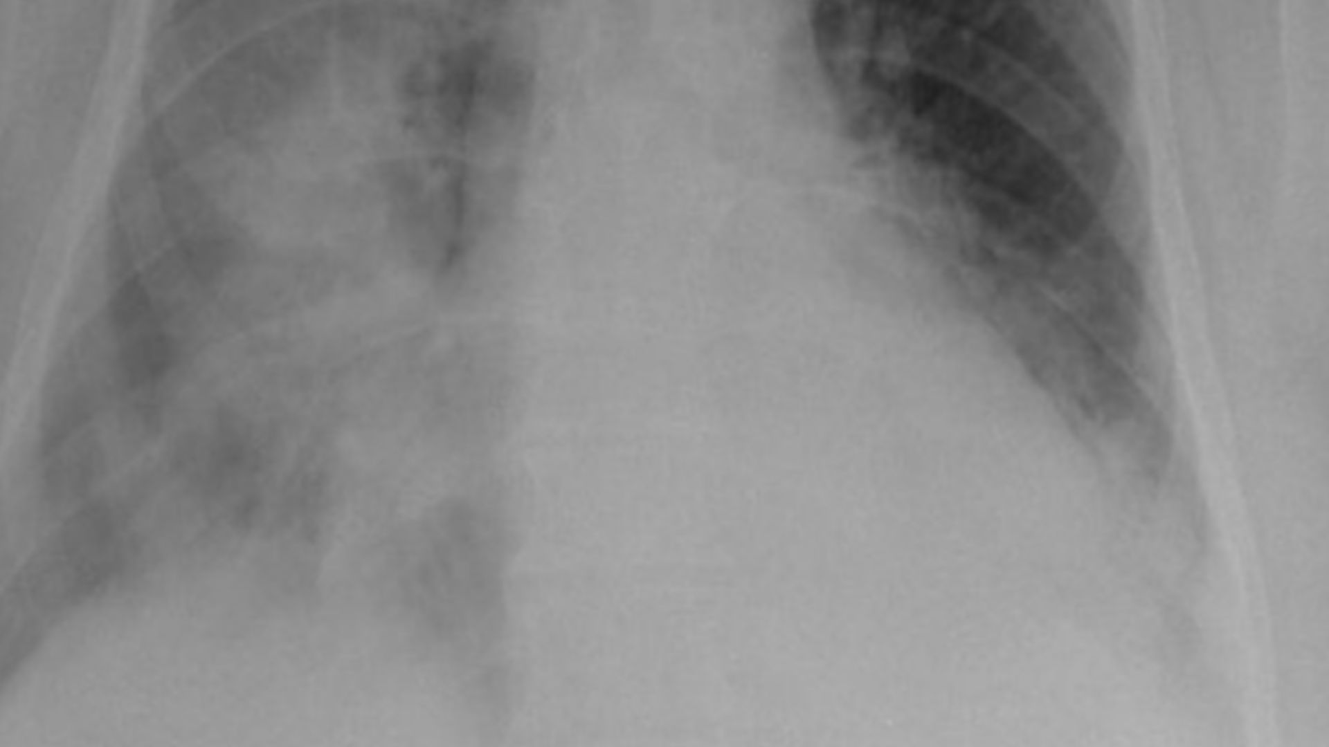 Chest X-ray (PA view) at initial presentation showing consol-

idation within the right mid and both lower lobes.