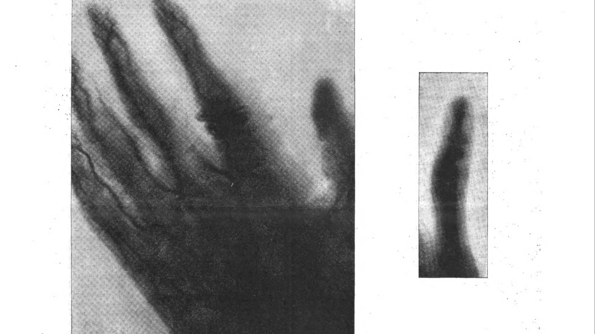 Angiogram of human hand, January 23rd, 1896
