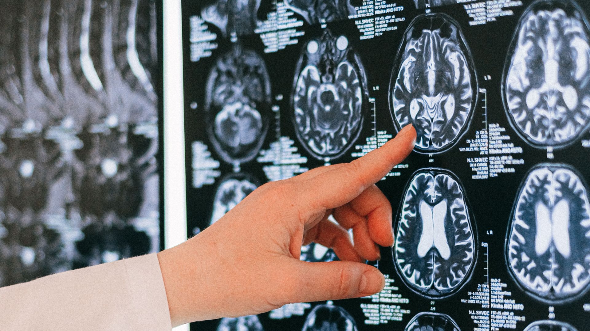 A doctor's hand points to a brain MRI scan on a lightbox, illustrating medical diagnosis.