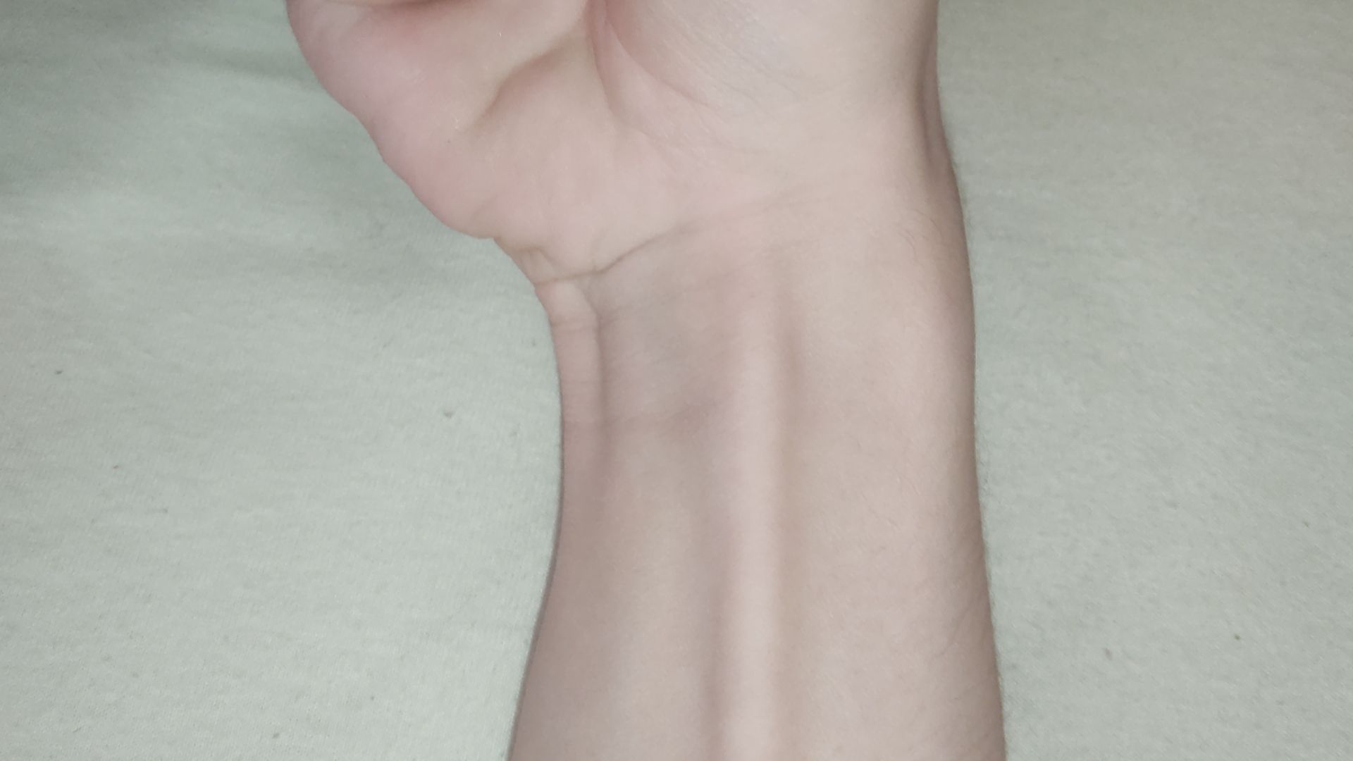 Picture of the palmaris longus tendon visible on the anterior aspect of the wrist when the wrist is flexed while touching the 1st and 5th digits together.