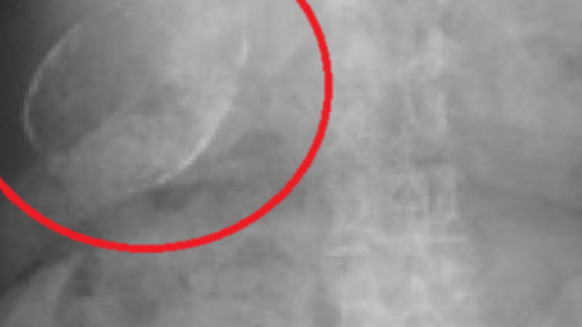 X-ray showing a porcelain gallbladder.