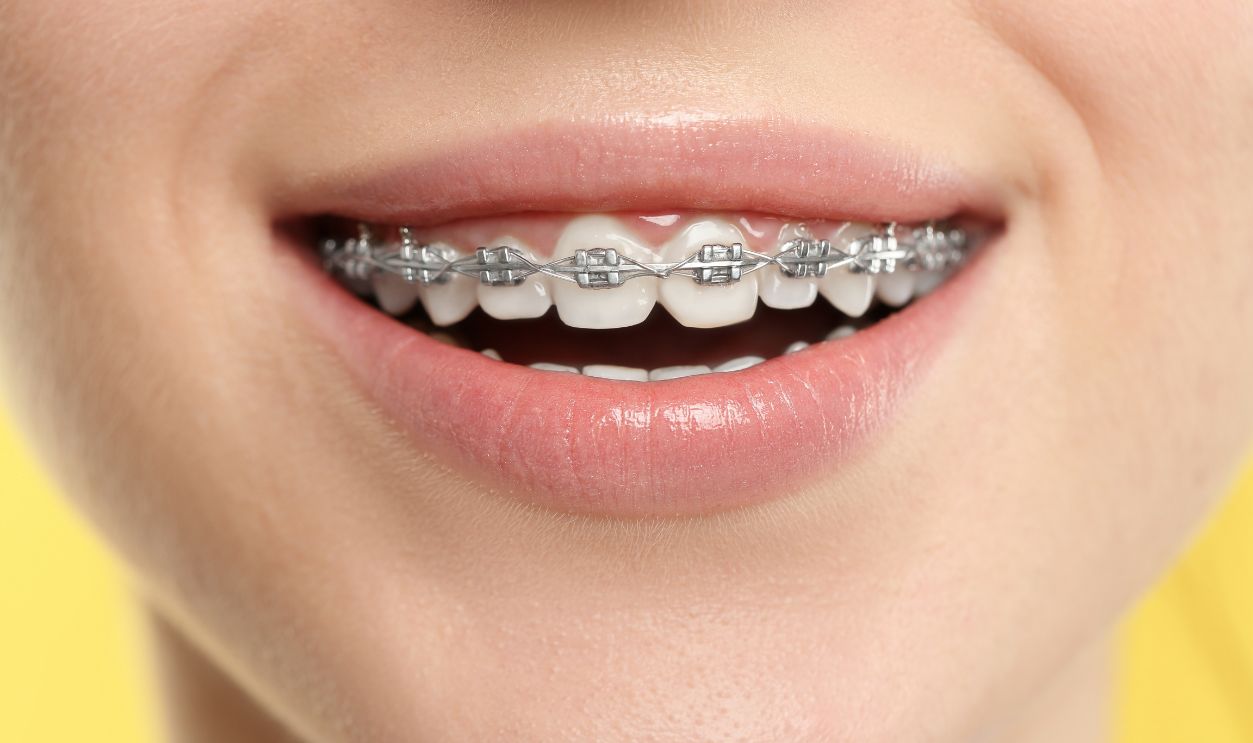 Smiling woman with dental braces on yellow background, closeup
