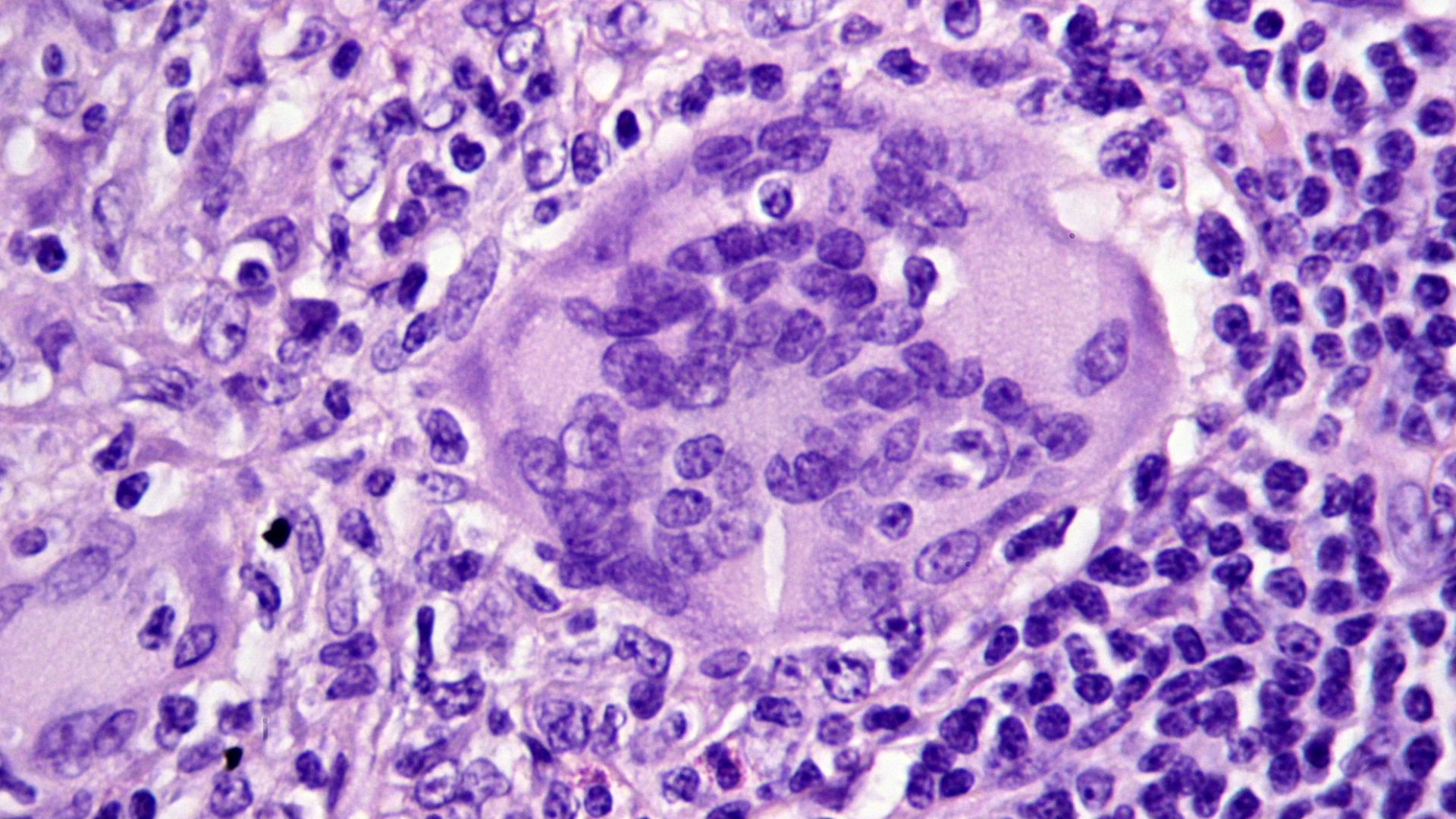 File:Granulomas in an intestinal lymph node in Crohn's disease, HE 4.JPG