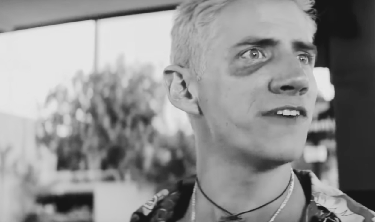 Jamie Kennedy’s Black Eye In Romeo + Juliet