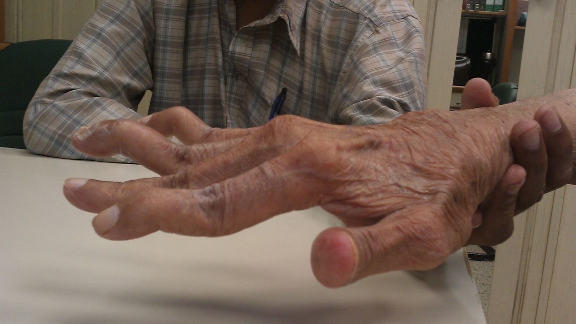 Swan neck deformity in a 65 year old Rheumatoid Arthritis patient.