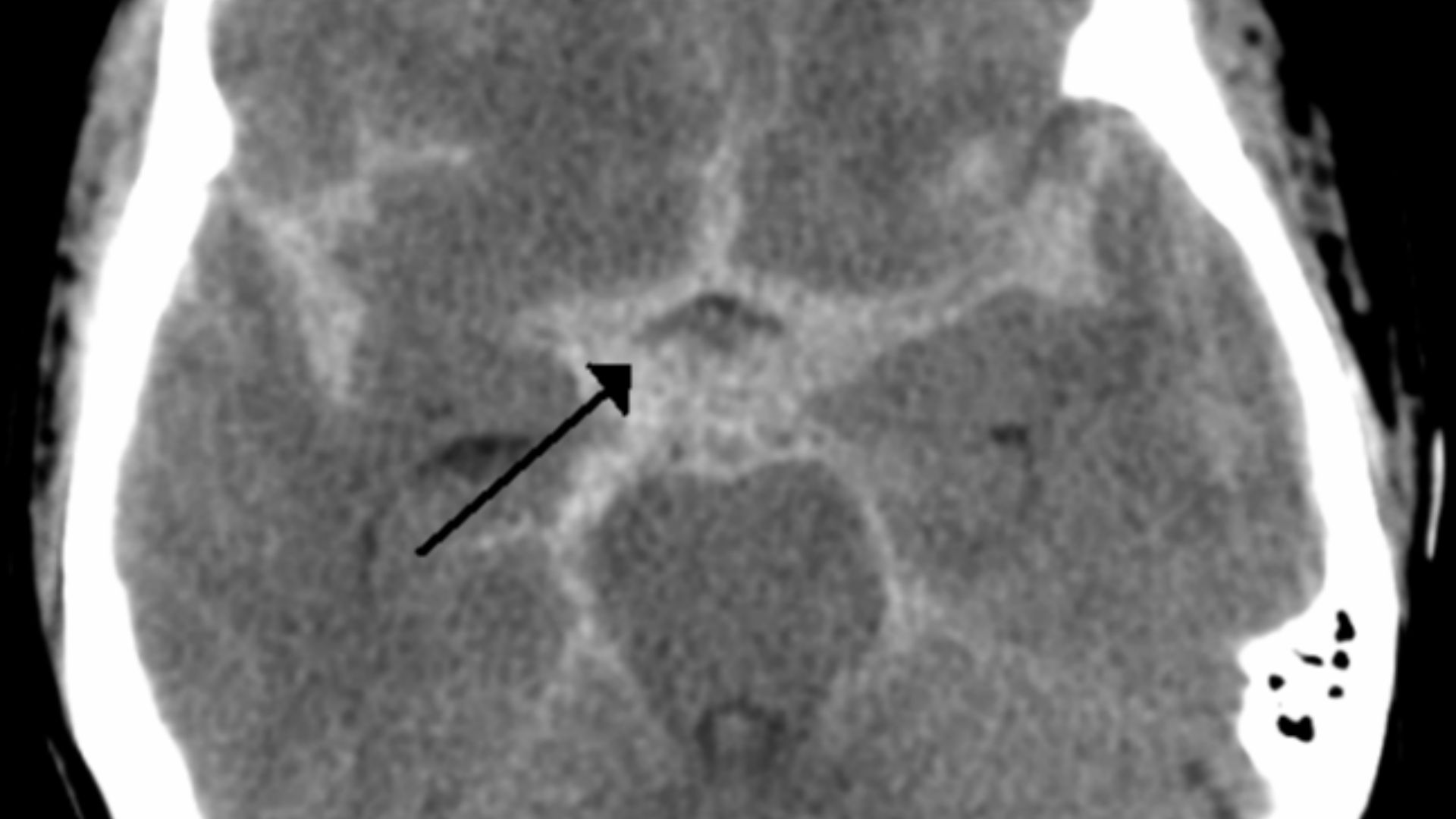 A subarachnoid hemorrhage.