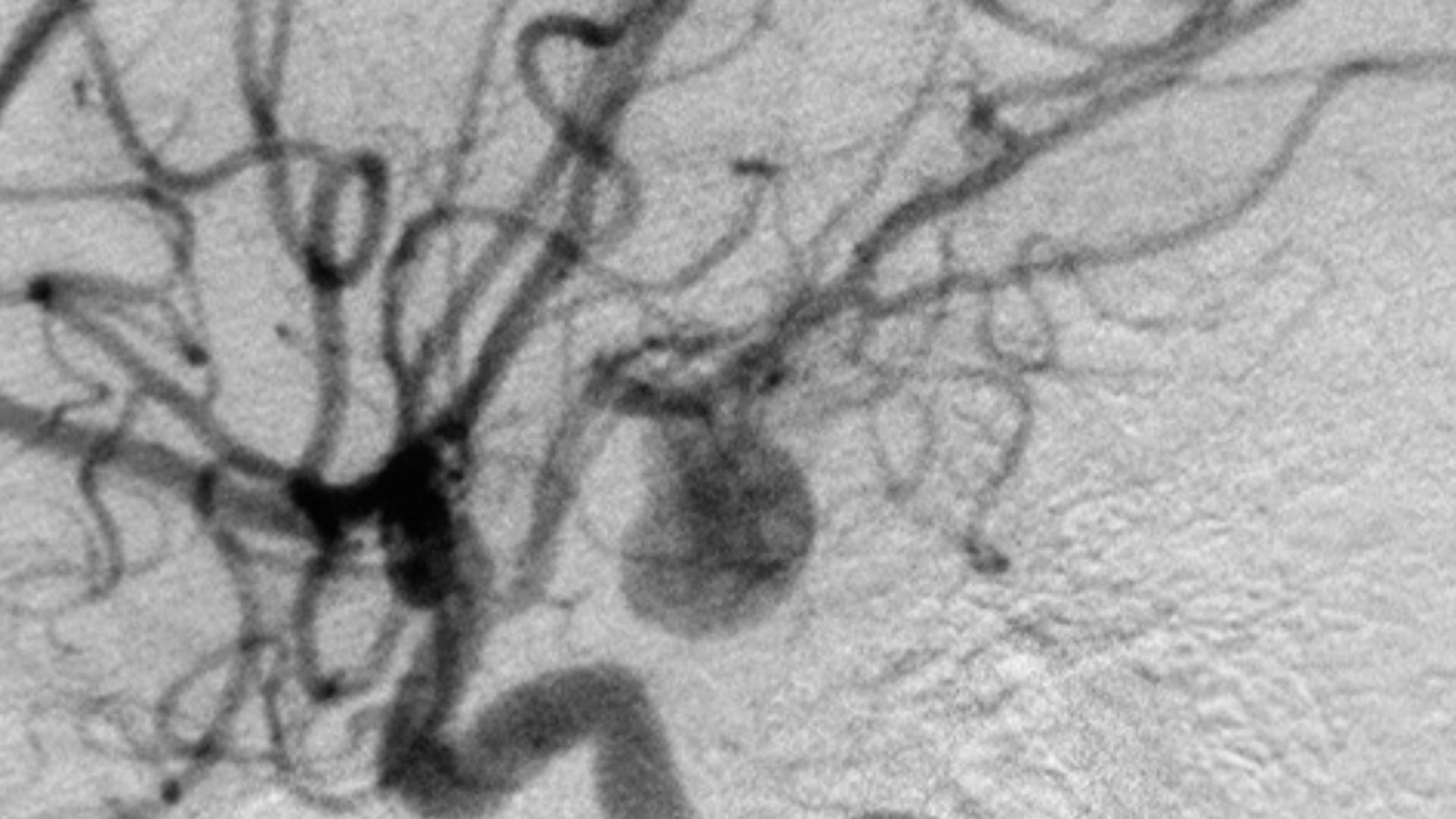 Angiograph of an aneurysm in a cerebral artery.
