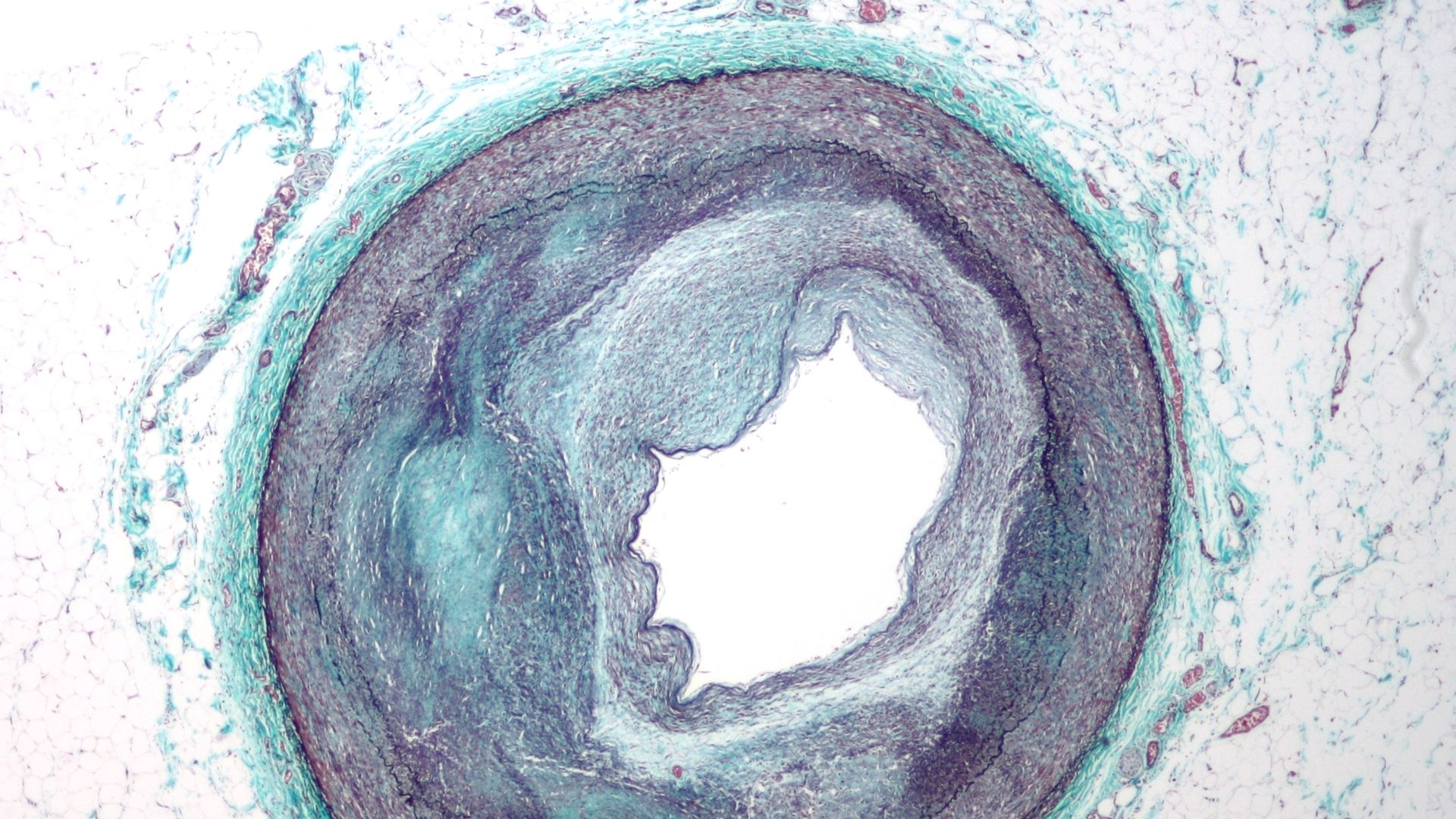 Low magnification micrograph of the distal right coronary artery with complex atherosclerosis and luminal narrowing. Masson's trichrome.
Arteries have three layers (tunica intima, tunica media and tunica adventitia).
These can be seen on the micrograph: