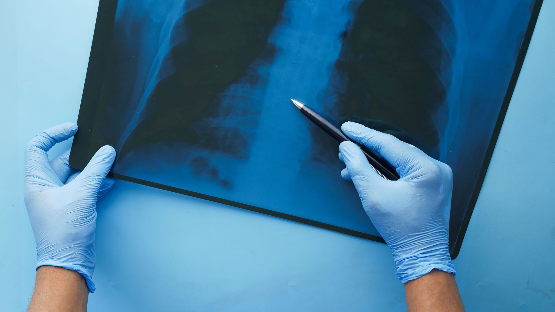 A doctor in blue gloves examines a chest x-ray with a pen, focusing on medical diagnosis.