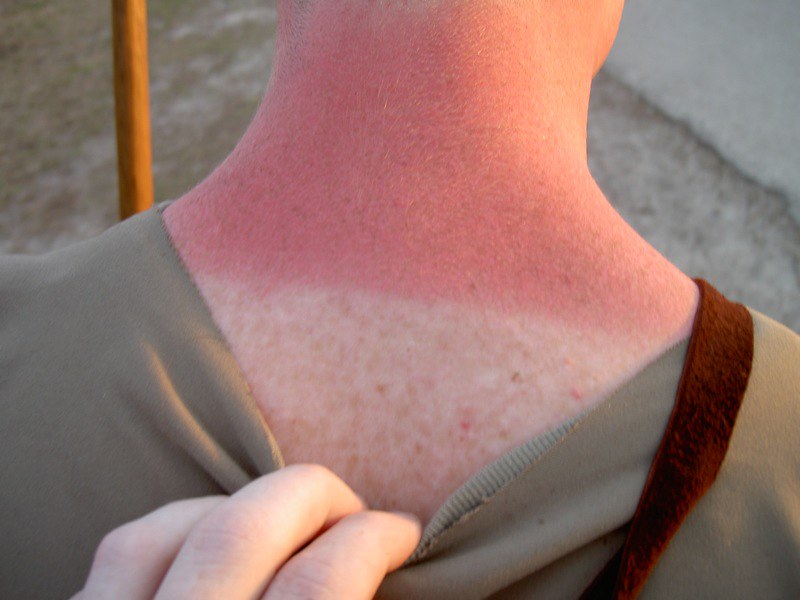 image of a person sunburn on neck