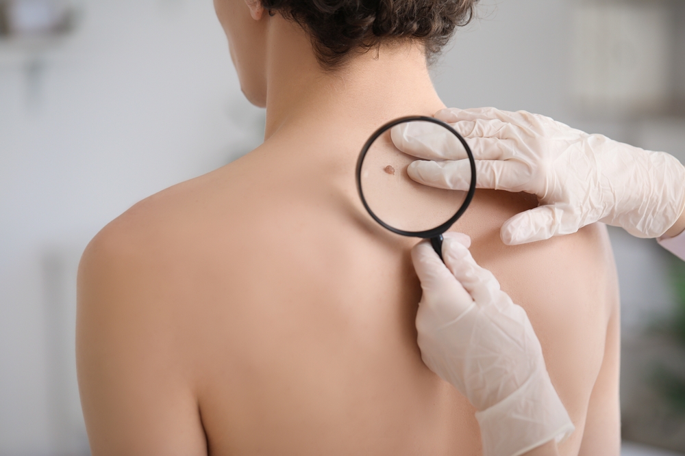 Dermatologist examining mole