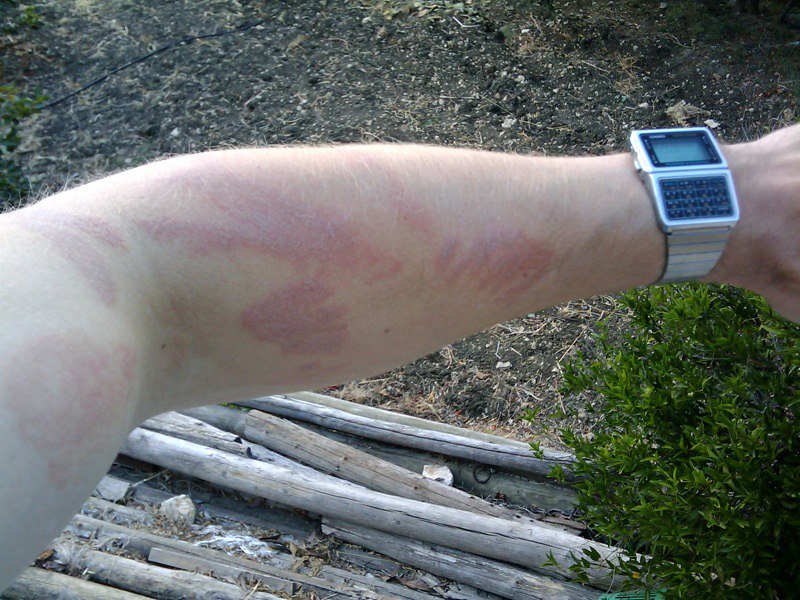 Jellyfish Sting