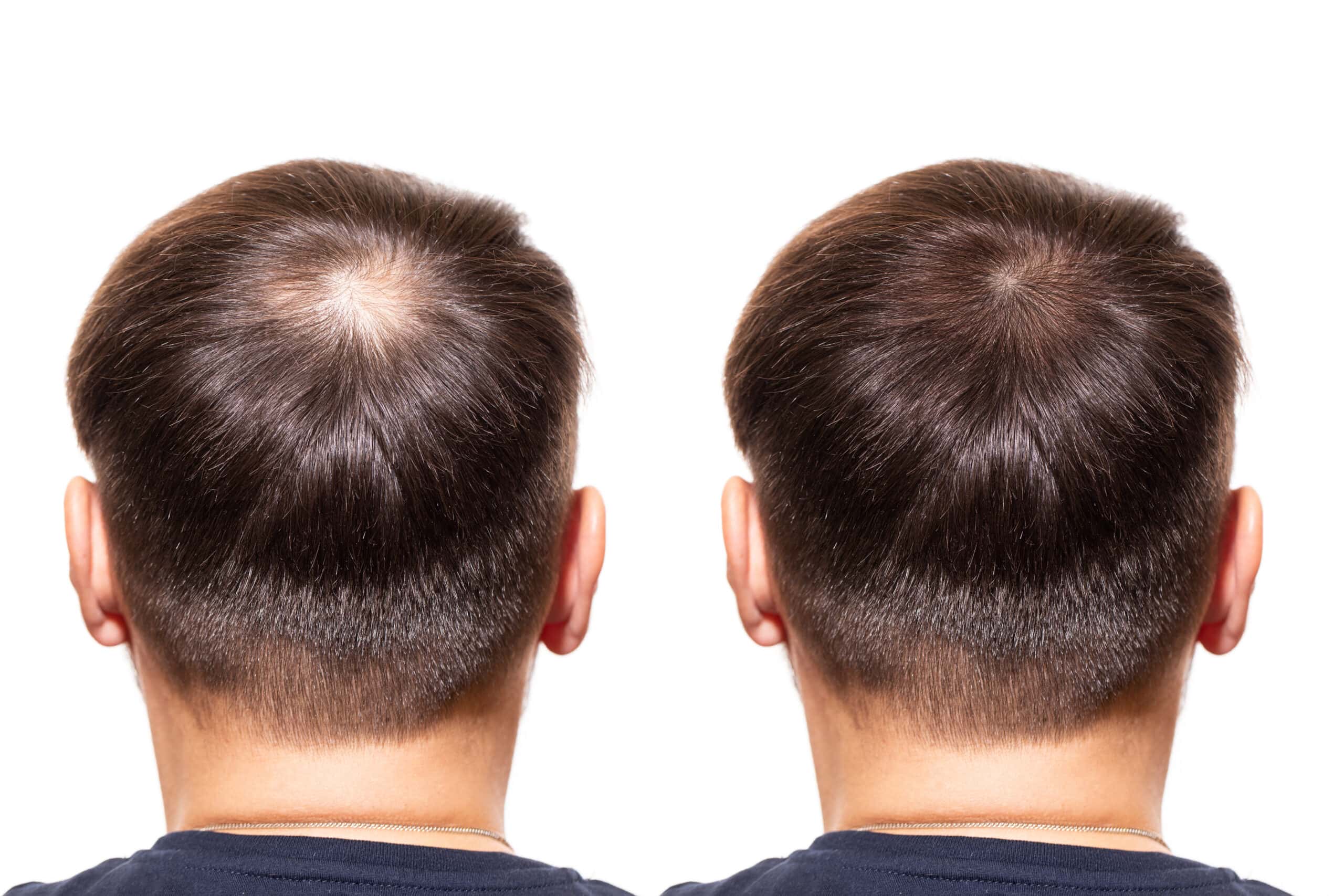 Preventing Hair Loss Review